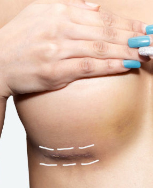 Mamoplastia